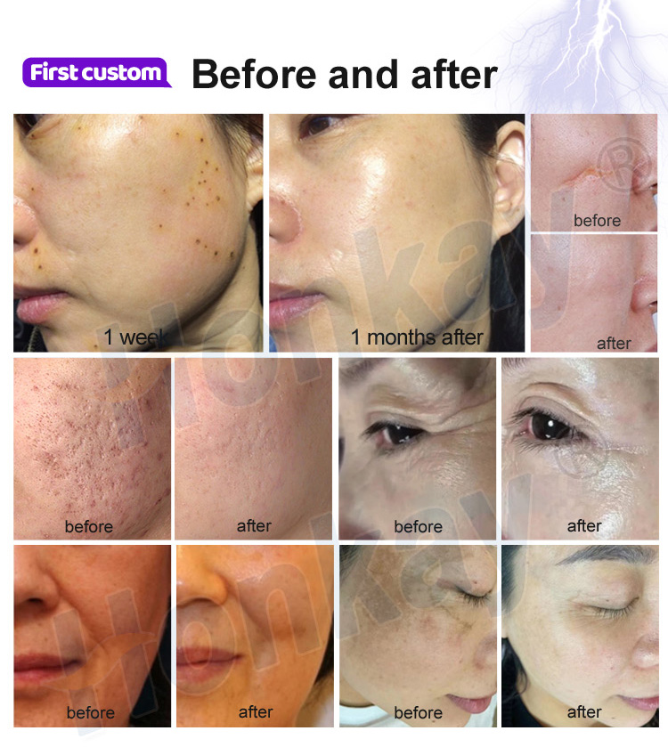 fibroblast plasma lift machine