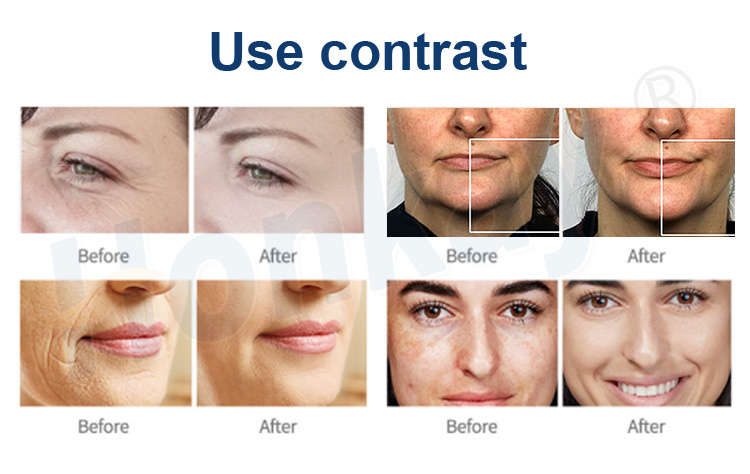 plasma pen wrinkle removal