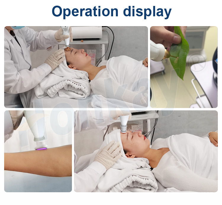 plasma pen wrinkle removal